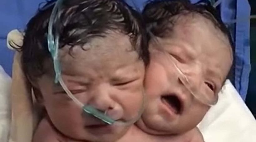 Από τα πιο σπάνια φαινόμενα: Γεννήθηκε μωρό με δύο κεφάλια (pic- vid)