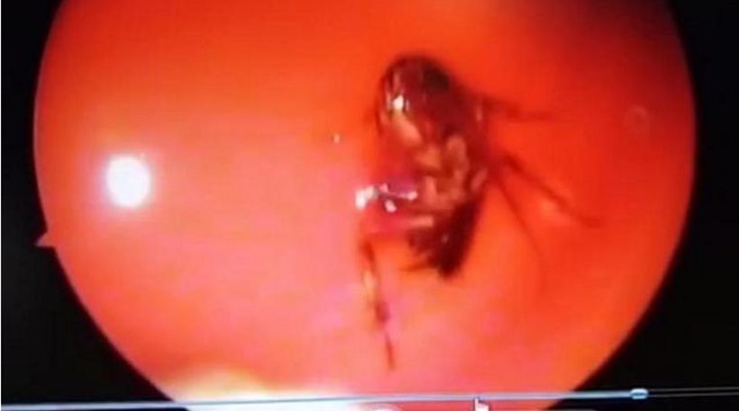 Ανατριχίλα: Γιατροί έβγαλαν από το κρανίο της… κατσαρίδα! Ζωντανή! (video)