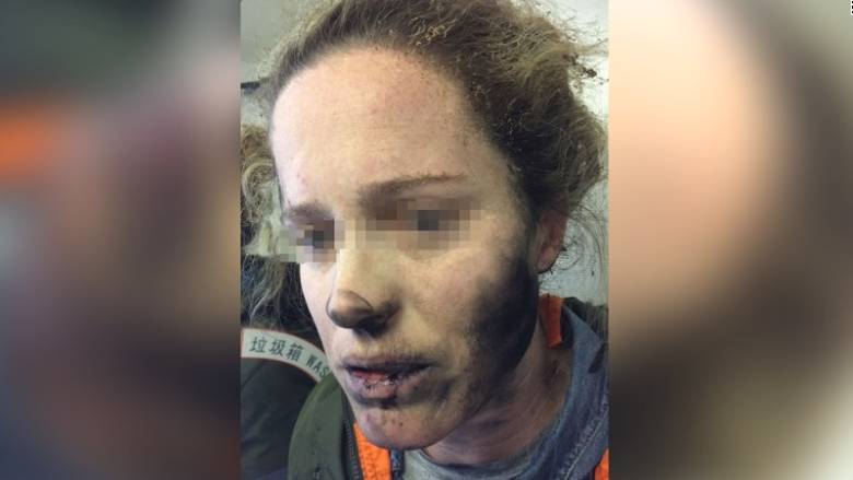Πανικός στην πτήση: Πήραν φωτιά τα ακουστικά και της έκαψαν το πρόσωπο (photos)