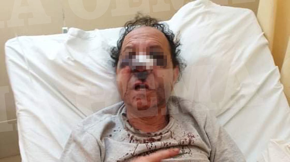 Εξάρχεια ξυλοδαρμός: Κακοποιοί ξυλοκόπησαν 63χρονο για να του πάρουν το κινητό