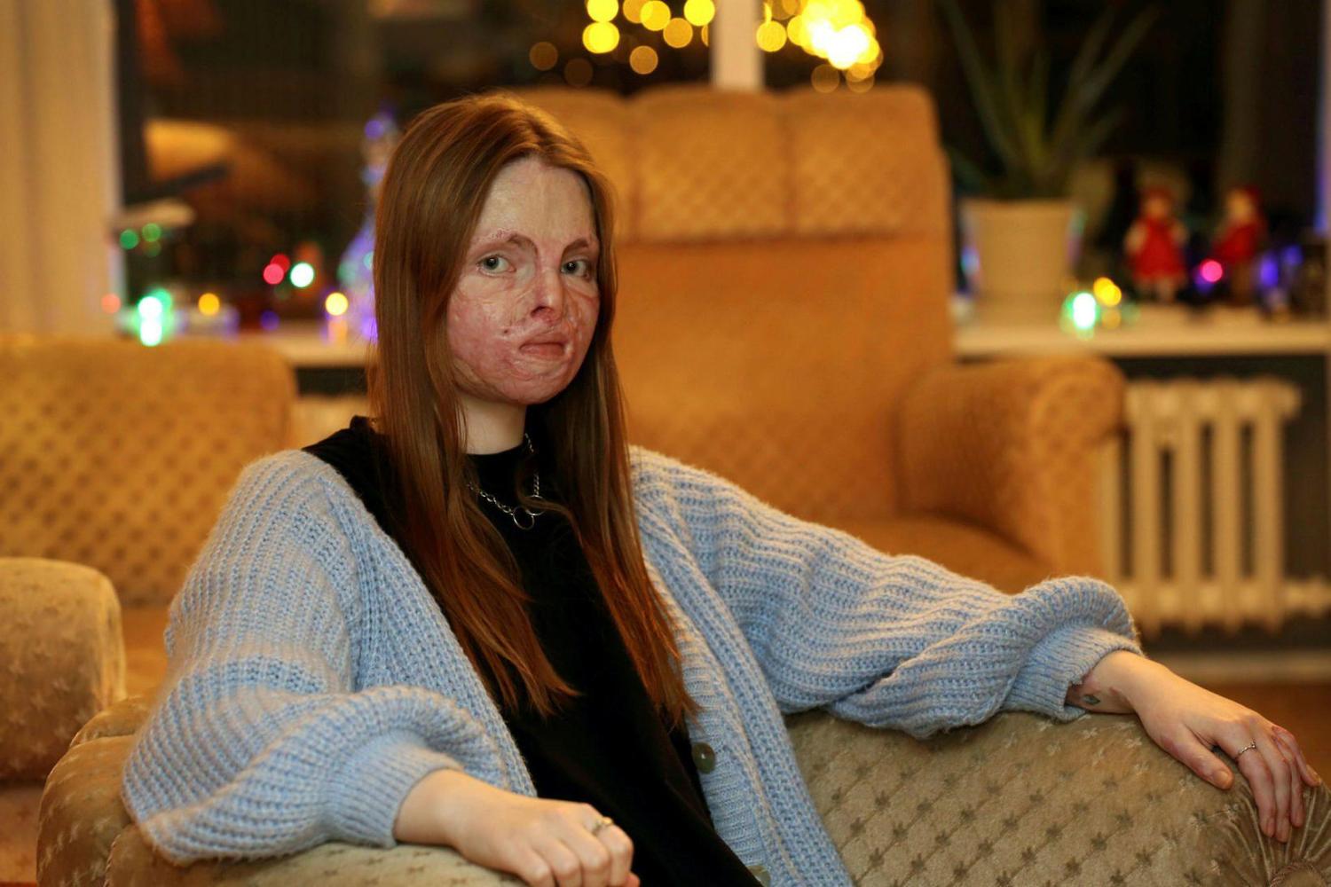 Εγκαύματα στο πρόσωπο: 24χρονη δίνει μαθήματα ζωής